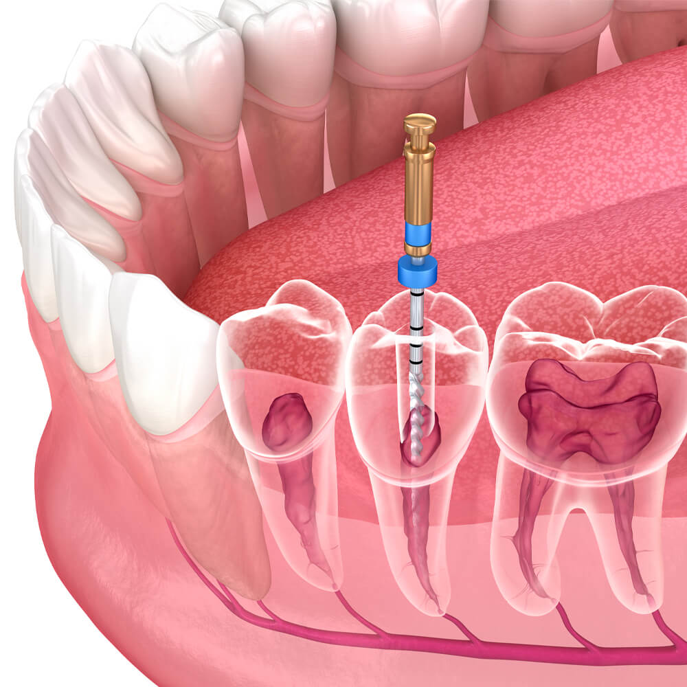 endodoncia