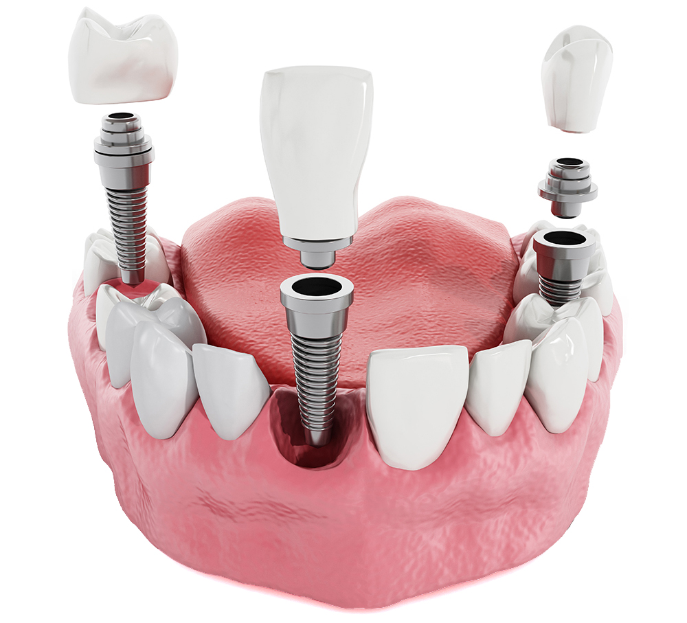 implantes dentales