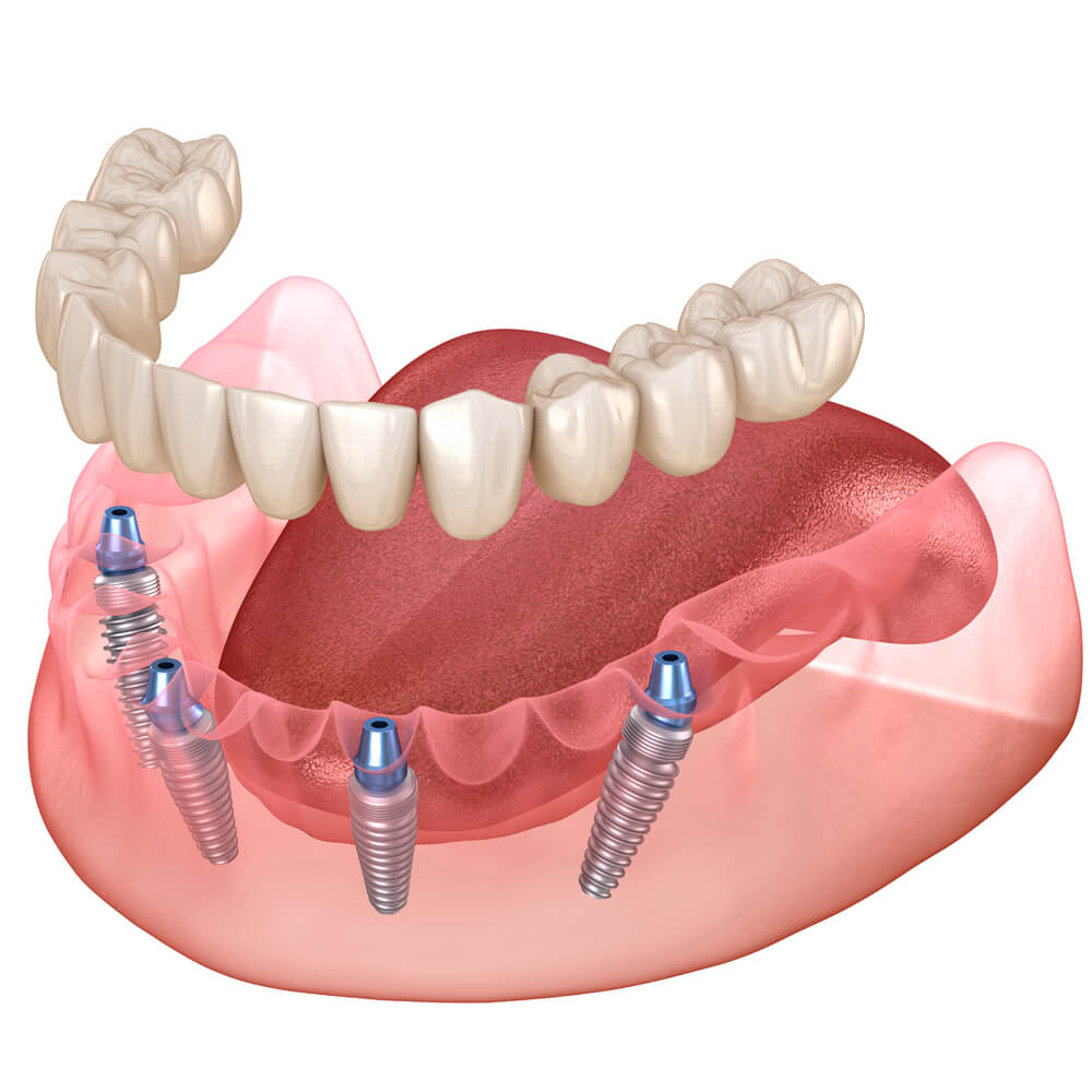 protesis dental